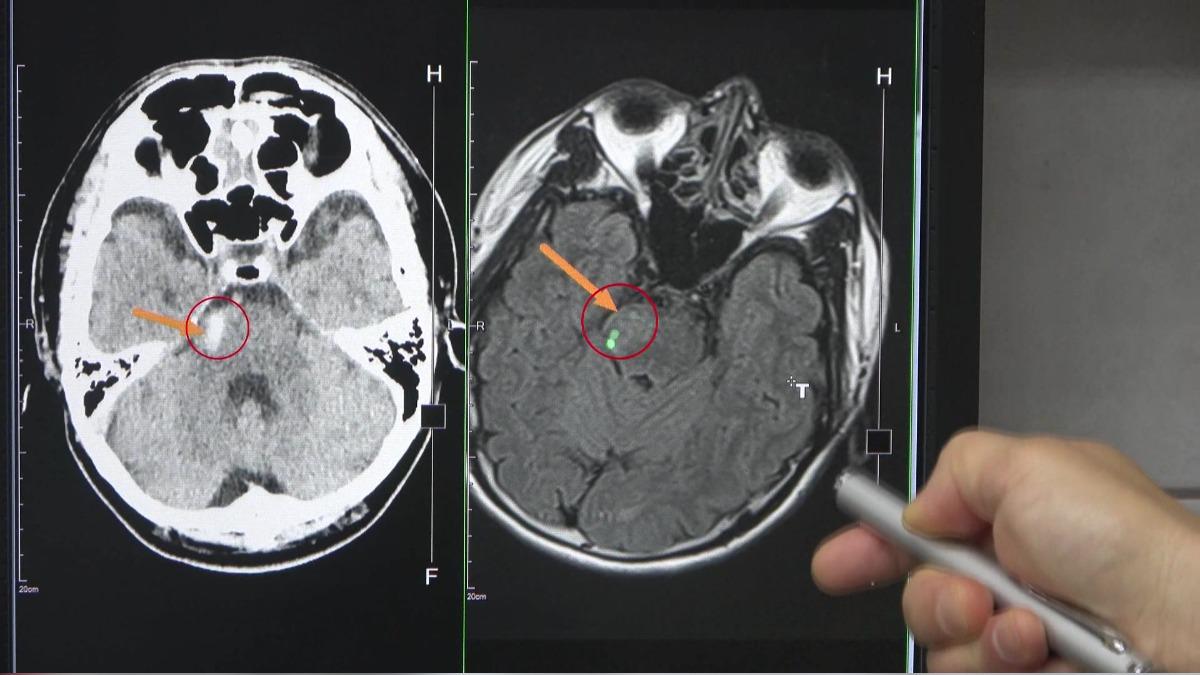 45歲貨車司機腦幹出血　醫：致死率高達九成。(圖／大甲李綜合醫院提供)