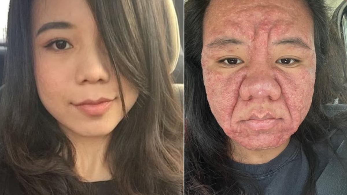 大馬女面目全非!懷孕荷爾蒙害臉紅腫、法令紋暴增 驚人對比曝
