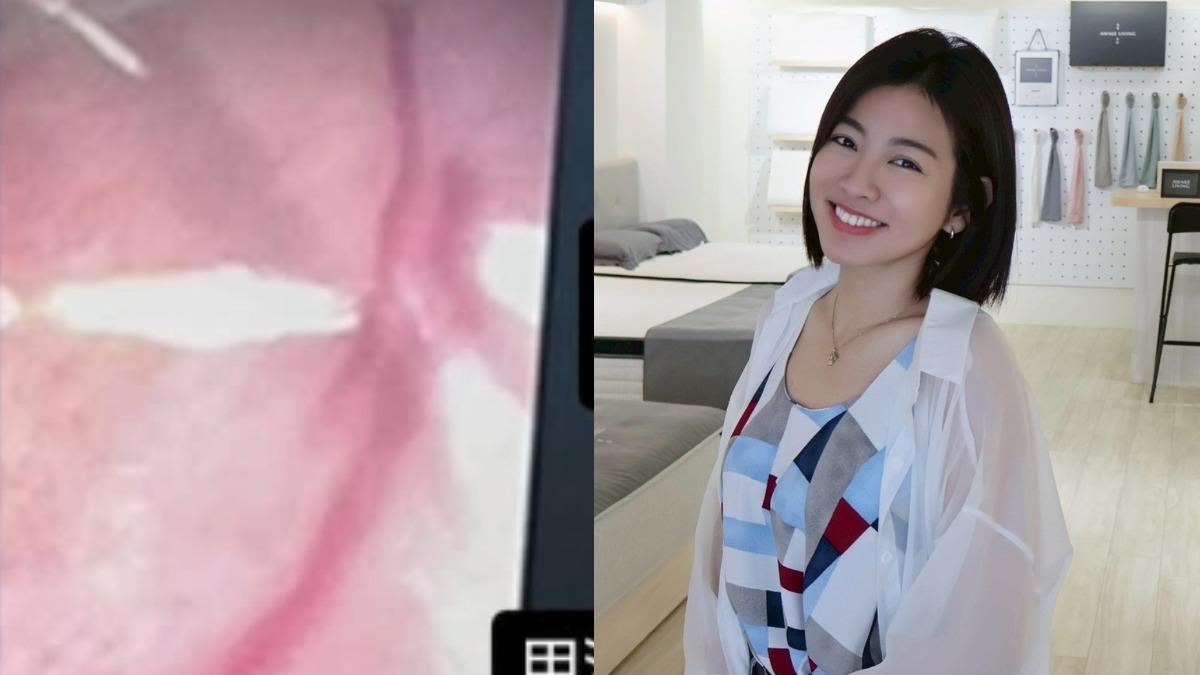米可白連3天流鼻血驚見「2刀劃痕」　急照頭顱X光！年底將動手術