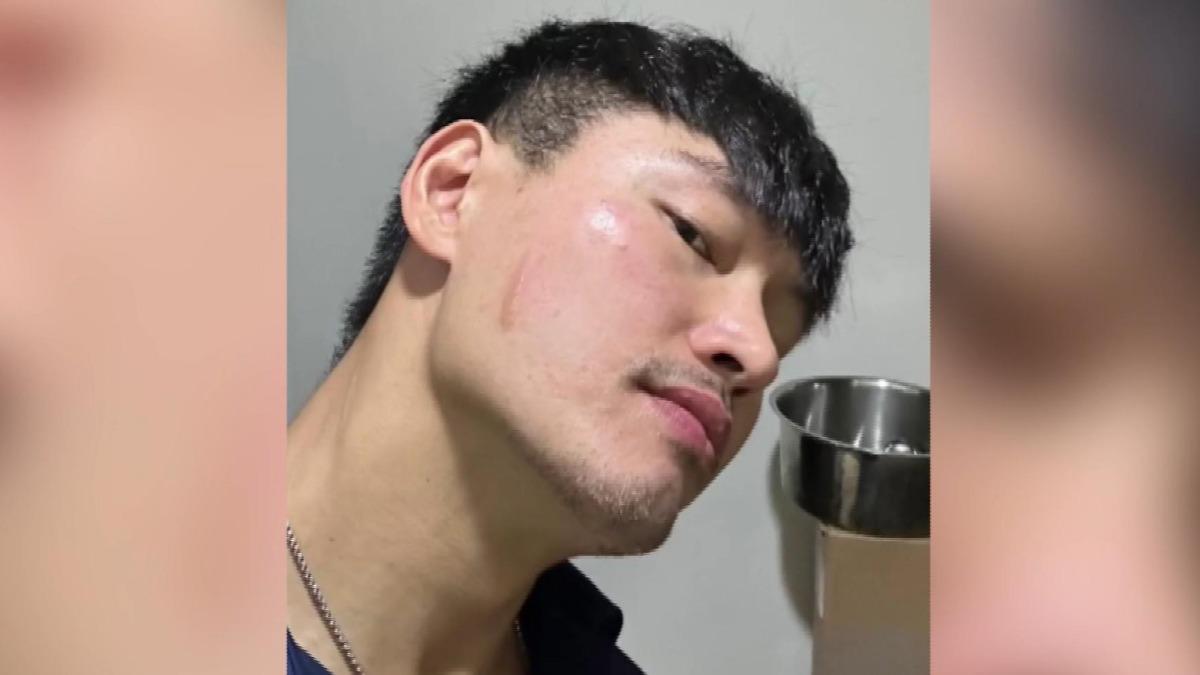 臉上還留下了一道二度灼傷的痕跡。(圖／threads/kb_firefighter)