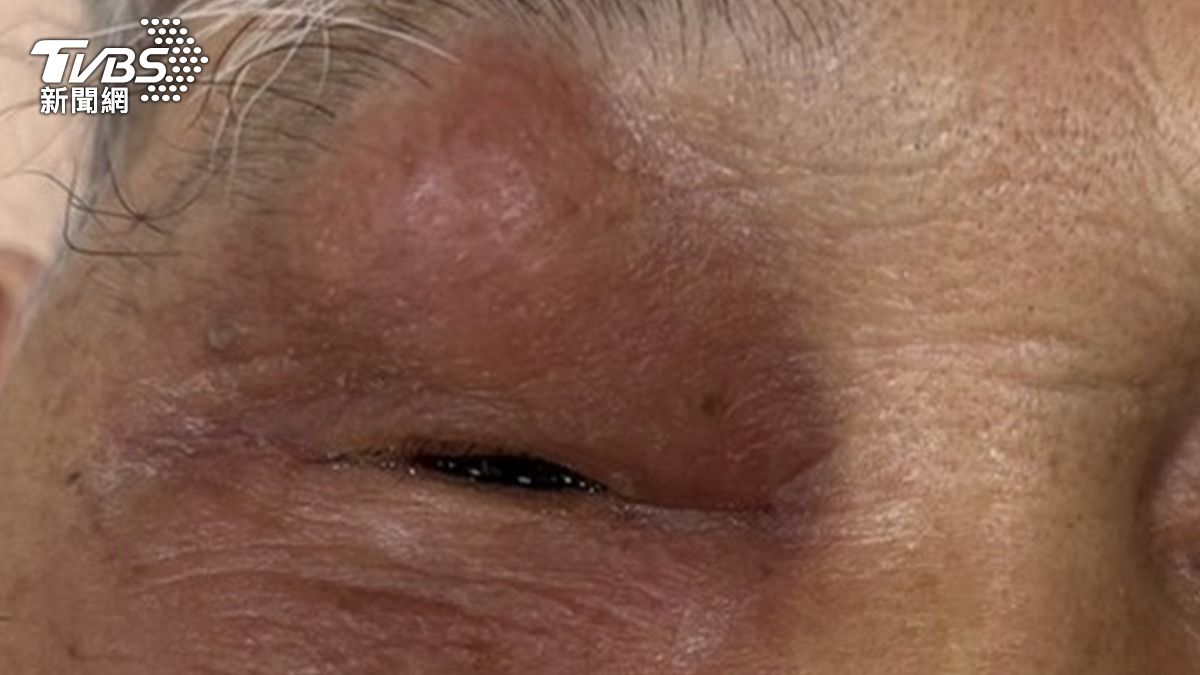 84歲爺爺眼睛腫大「視力模糊」　醫檢查：問題在鼻子