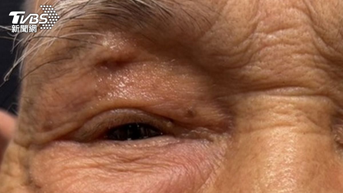 李爺爺經微創手術後,右眼消腫。(圖/慈濟醫院提供)