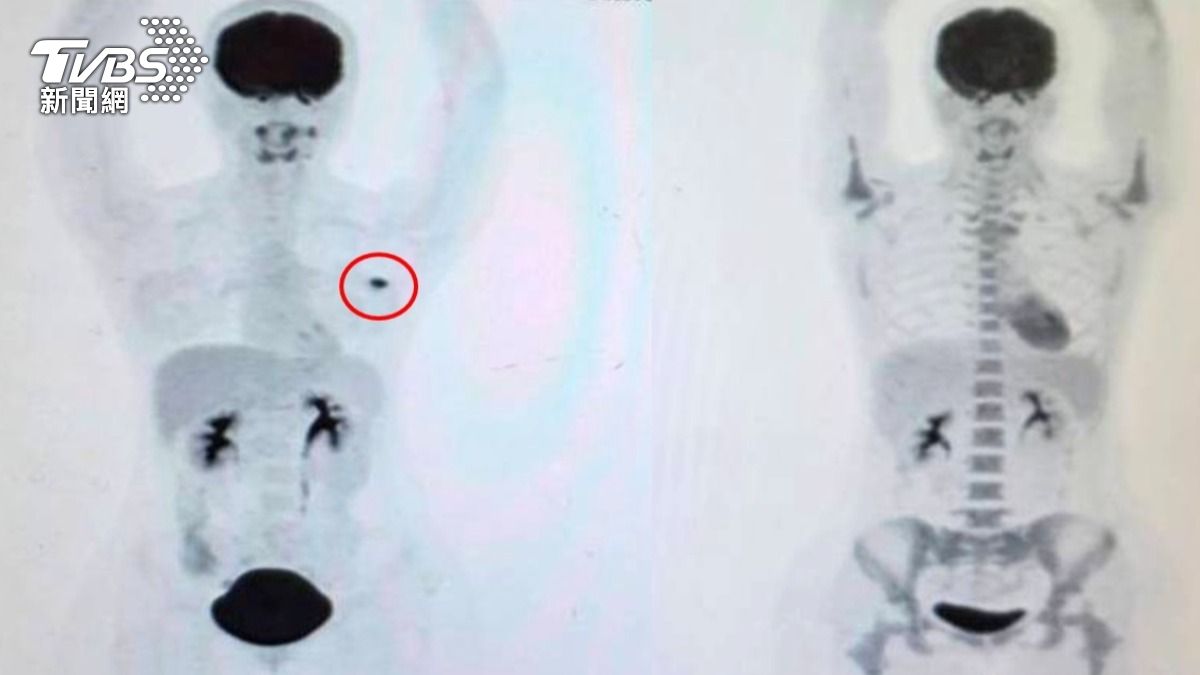 三陰性乳癌最兇狠?37歲女術後「零癌細胞」 醫揭治癒關鍵