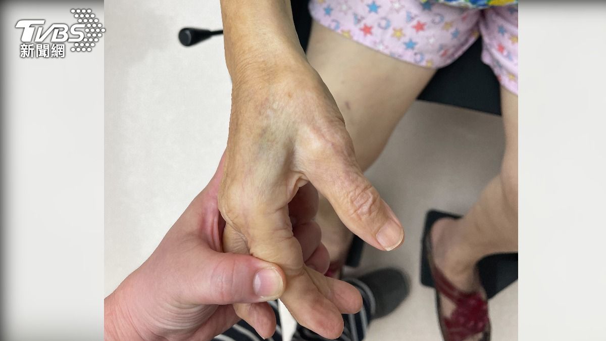 90歲奶奶虎口出現瘀青，懷疑是遭到看護毆打。（圖／家屬提供）