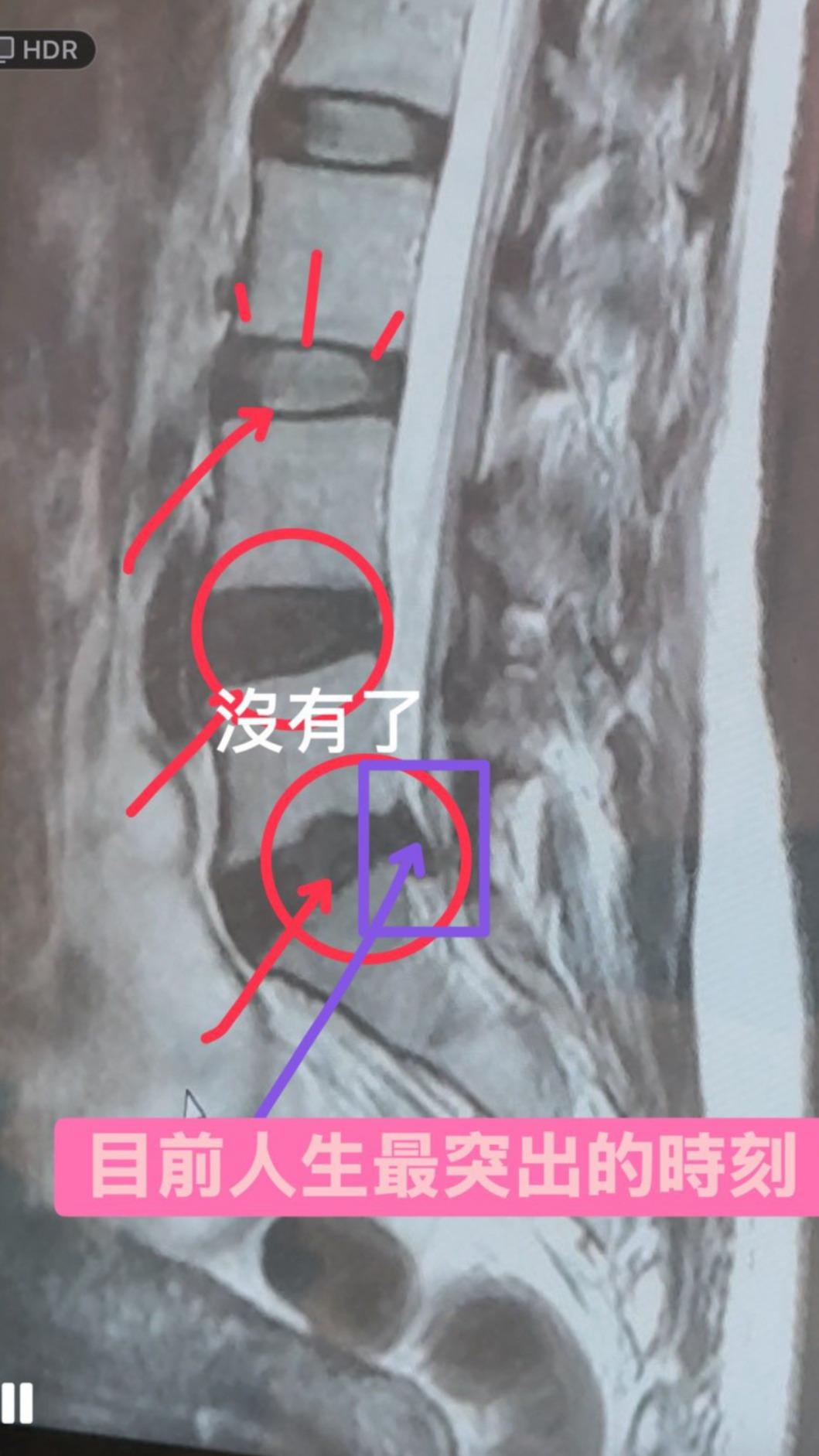 萁萁日前因椎間盤突出住院開刀。(圖/翻攝萁萁臉書)