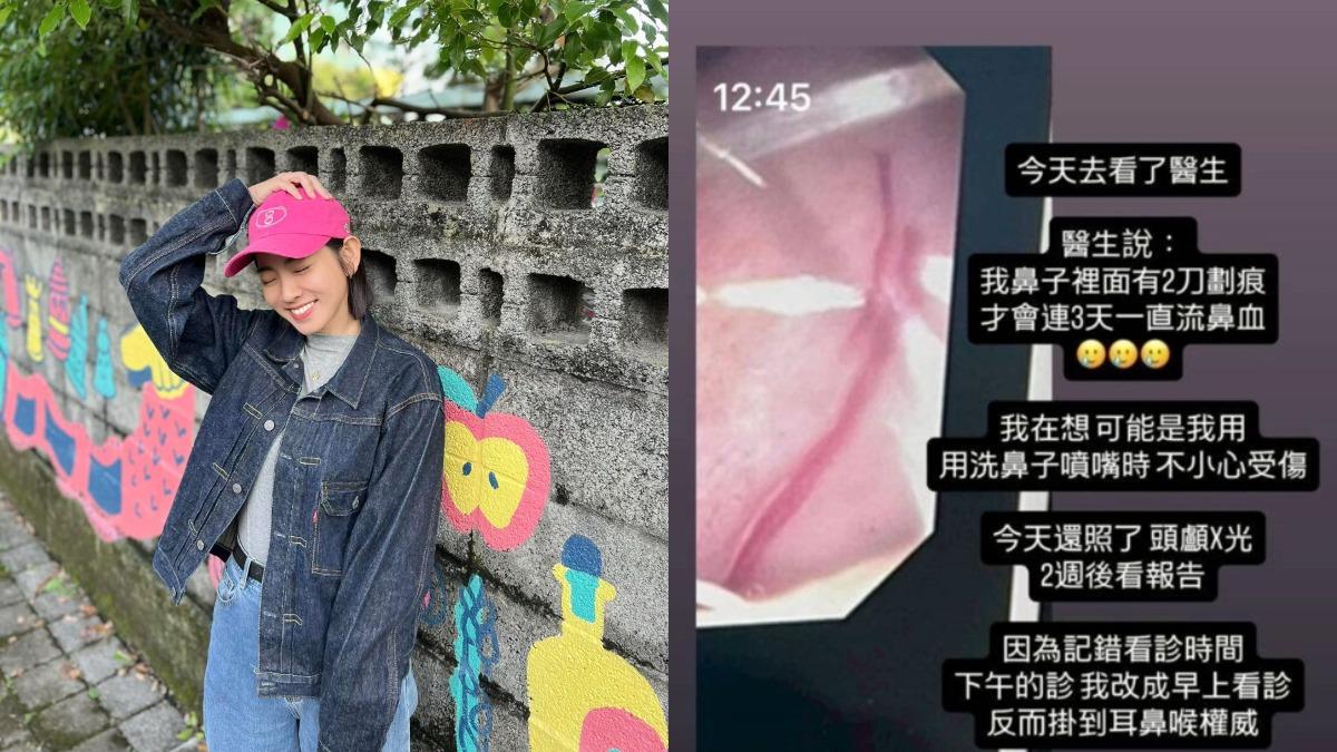 米可白過敏洗鼻反覆流鼻血!醫示警:伴隨「4症狀」恐是鼻咽癌