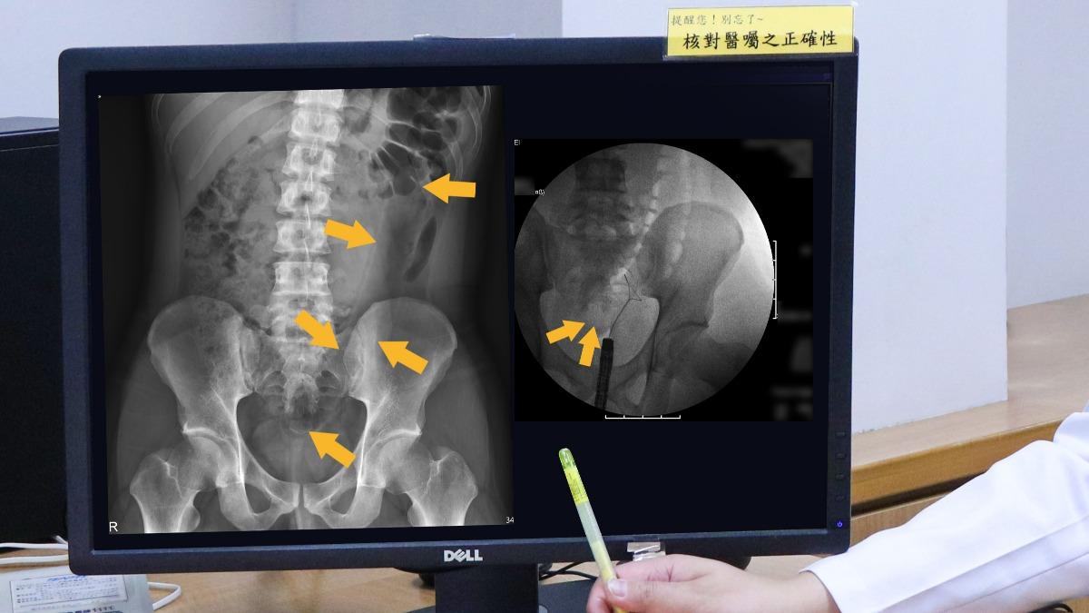 全台首例！男玩35cm按摩棒卡直腸　博愛醫院內視鏡免開刀取出