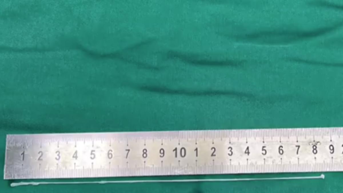 男子腦中取出18公分寄生蟲。 (圖/翻攝自微博@粵TV)