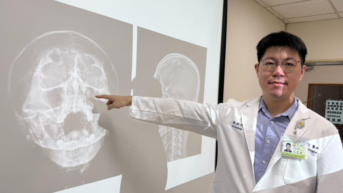 詹男左側鼻竇位置出現腫漲發炎現象,引發頭痛。(圖/台中醫院提供)