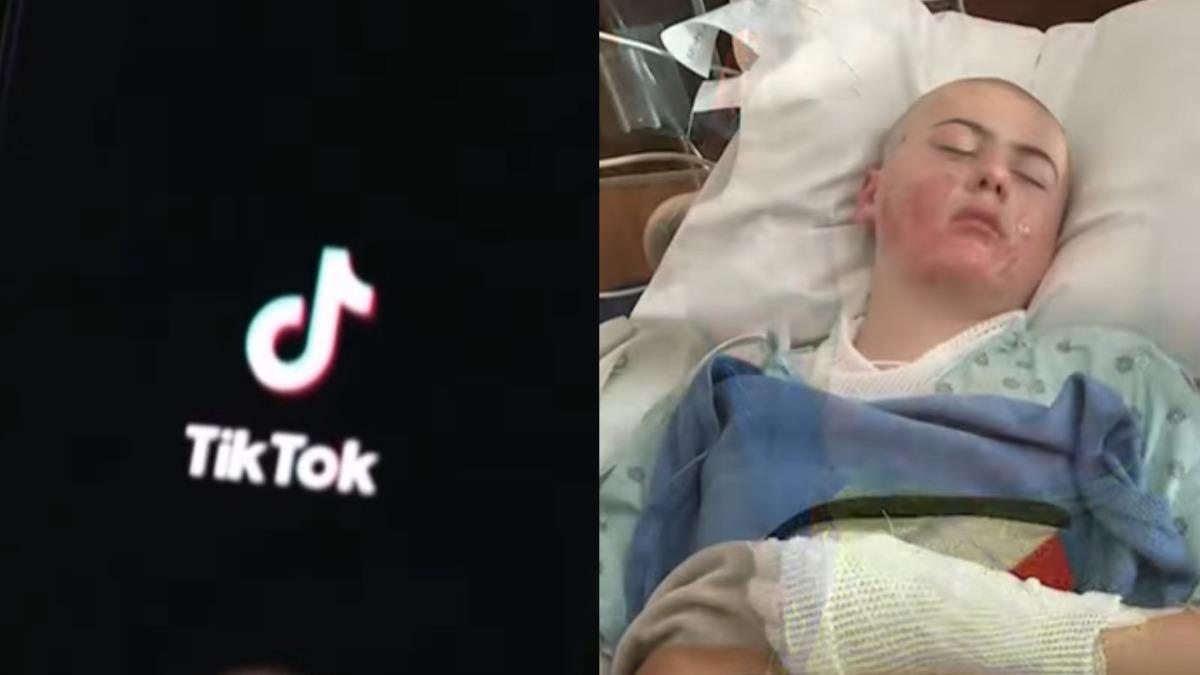 美12歲男童模仿TikTok實驗!衣服起火全身嚴重燒傷慘住院