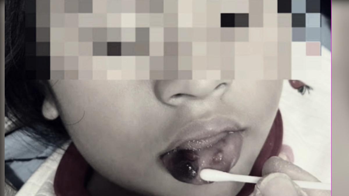 台東某國小附幼特教班女童遭教師踹傷、毆打,嘴唇破裂、鼻腔流血。(圖/家長提供)