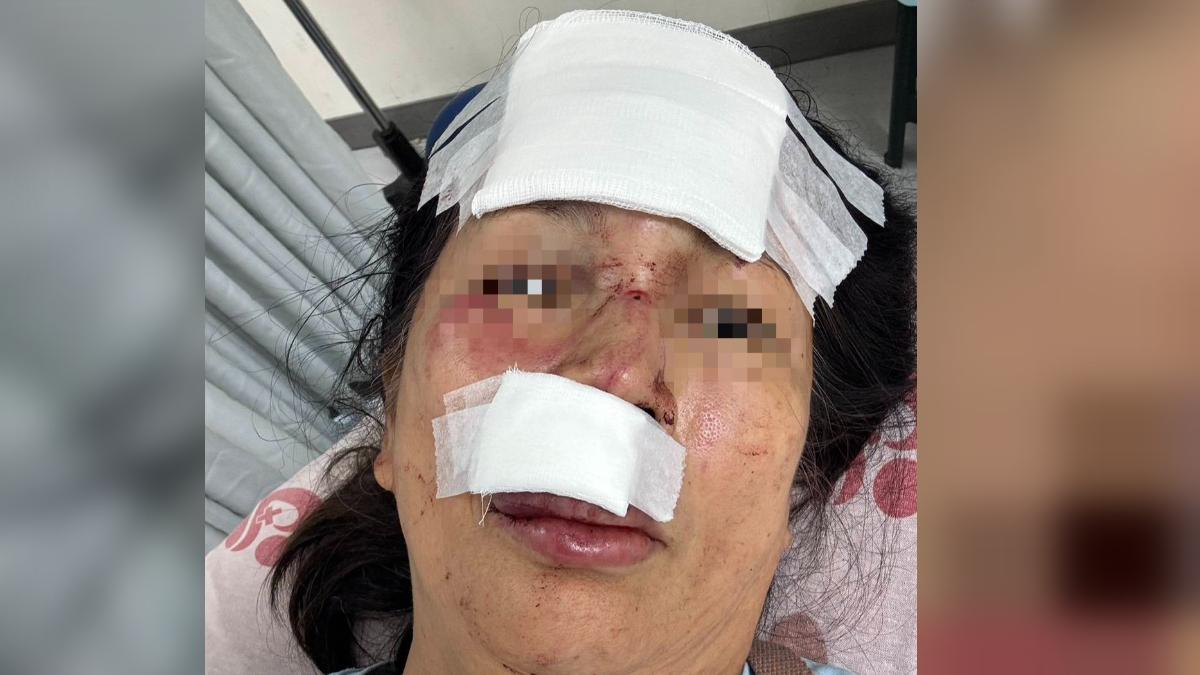 婦人鼻子、舌頭、嘴唇、牙齒嚴重受傷,緊急送醫縫了數十針。(圖/民眾提供)