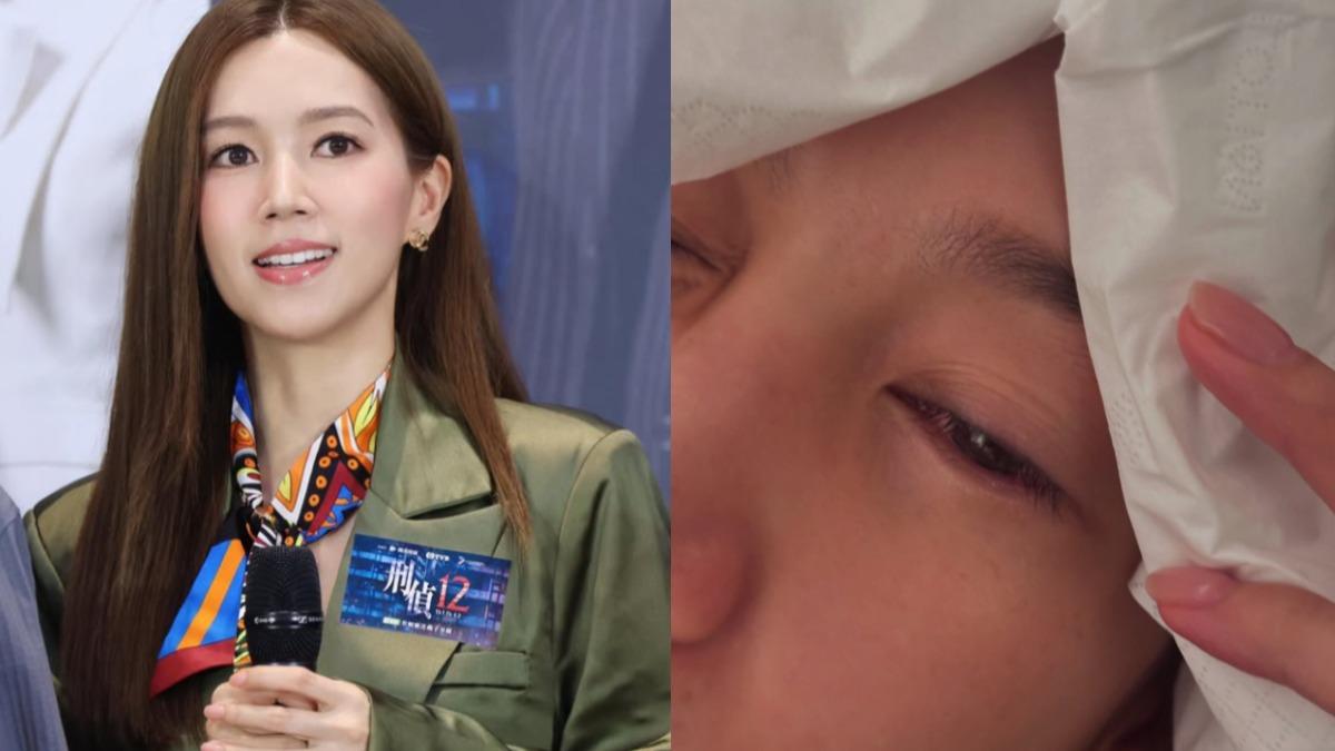 女星換衣服「割傷眼角膜」!傷勢惡化 送急診暴哭:痛到無法形容