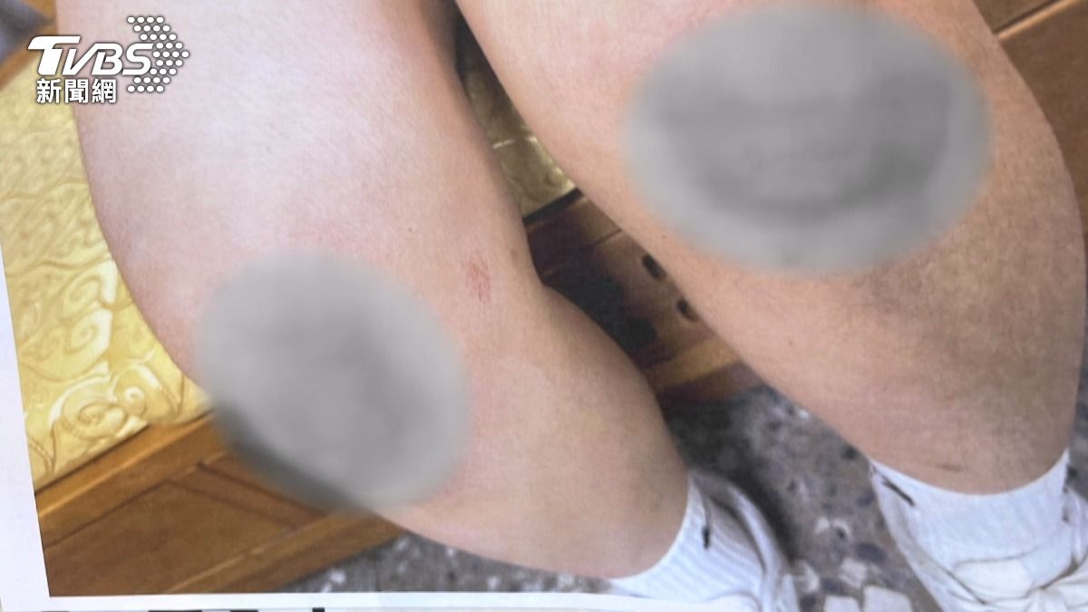 女高中生膝蓋有多處擦挫傷。(圖／當事人提供)