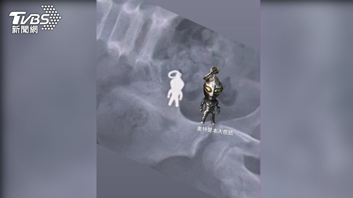 X光檢查影像清晰顯示,男童腹部有一個公仔形狀的異物,還能看出上面帶有吊環的特徵。(圖/TVBS)