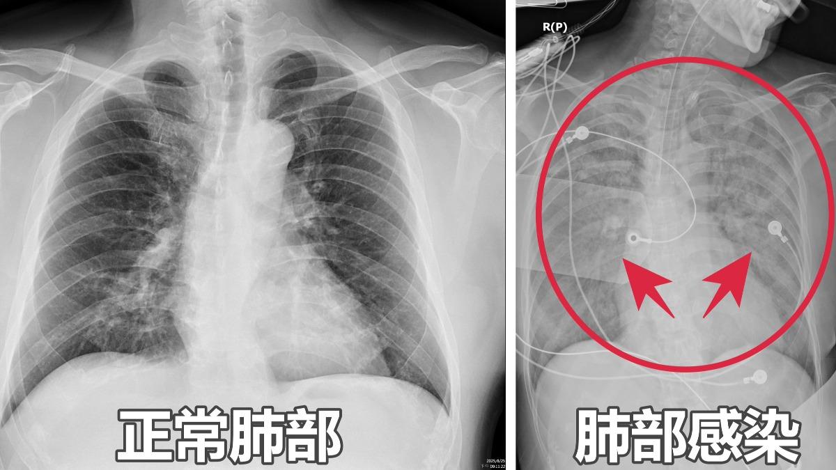 4族群超危險!台中婦染肺炎厭食狂咳 X光一照「全是白的」