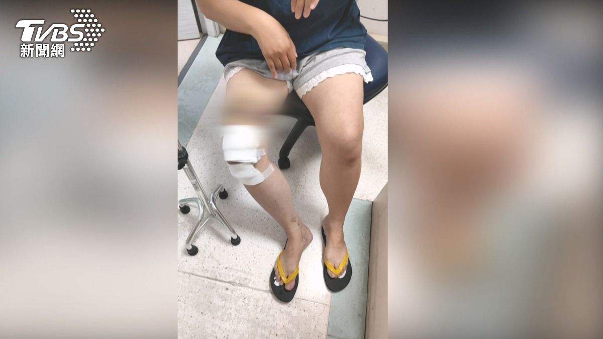 黃姓女騎士因視線不佳,撞到了倒地的機車自摔,整隻腳一大片瘀青,膝蓋也腫一大包。(圖/TVBS)