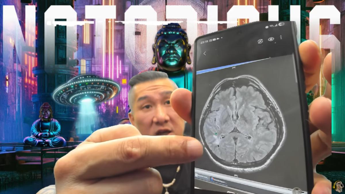 館長在直播中秀出腦部X光片。(圖/翻攝自館長惡名昭彰YouTube)