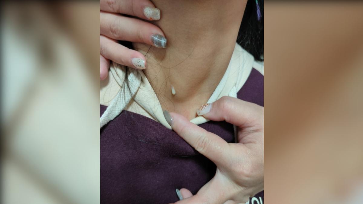 不是皮膚發炎!女童脖子有小洞「狂流超臭黃膿」 醫示警及早切除