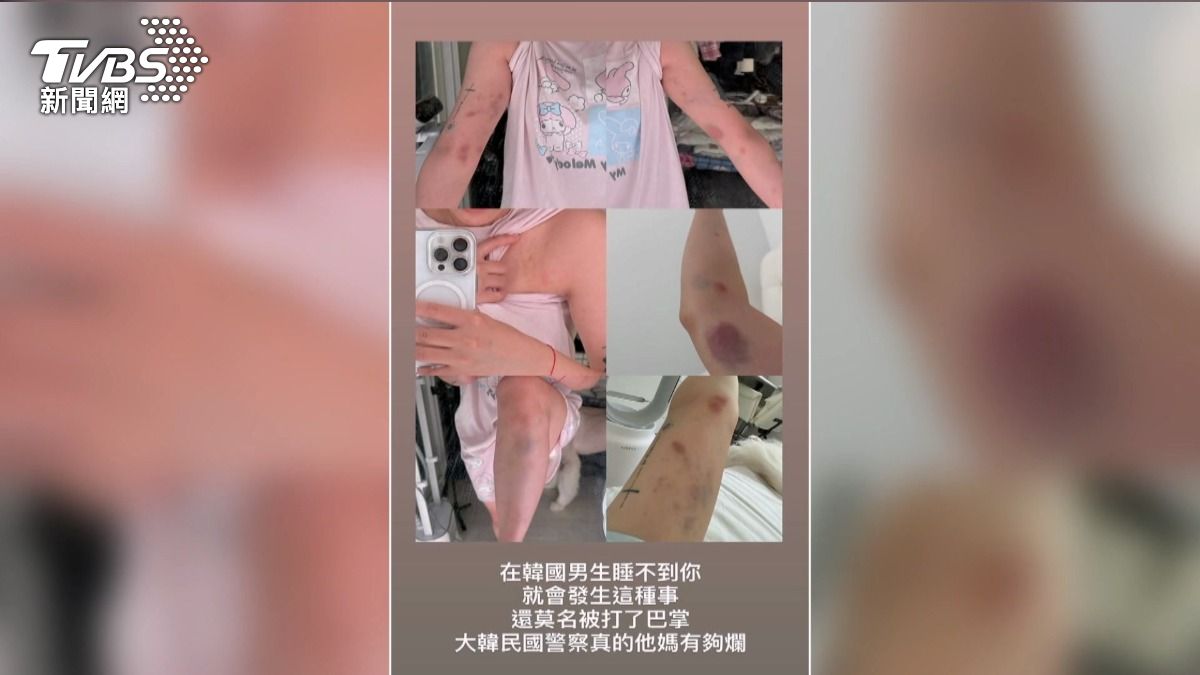 台YTR拒韓男搭訕遭毆 全身瘀青手指骨折。(翻攝YT Sean Solo)
