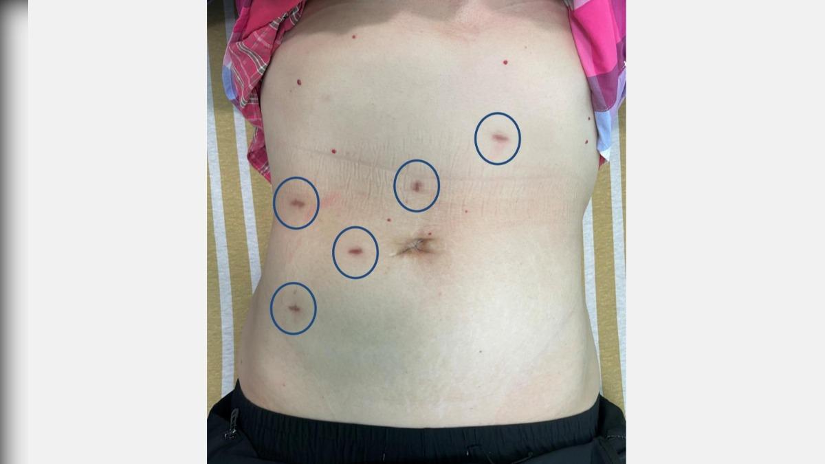 恐怖大腸癌成因未知!婦陪尪健檢反成主角 四期存活率30%