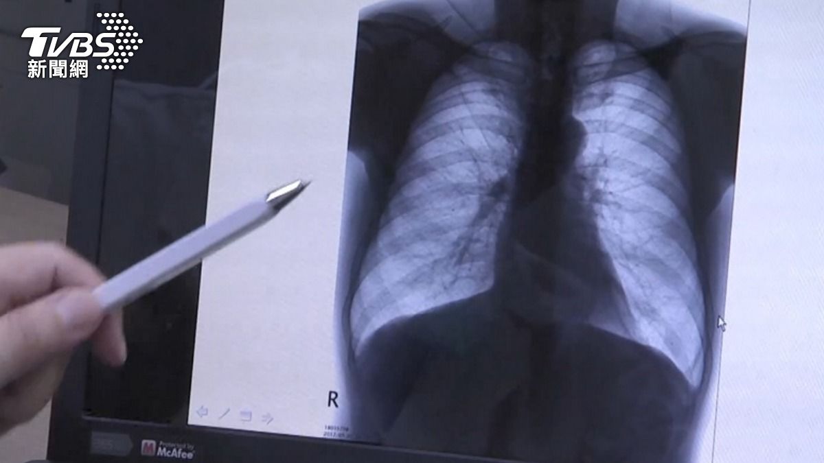 30歲台男驚見「肺部滿天星」! 醫聽職業:肺癌風險增1.5倍
