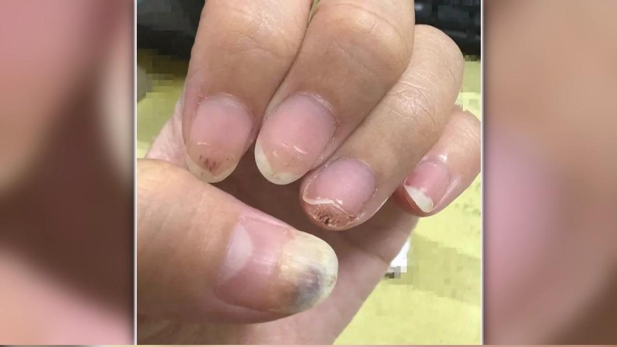 女子指控美甲師「弄傷手指」驚染病毒疣。(圖/當事人提供)