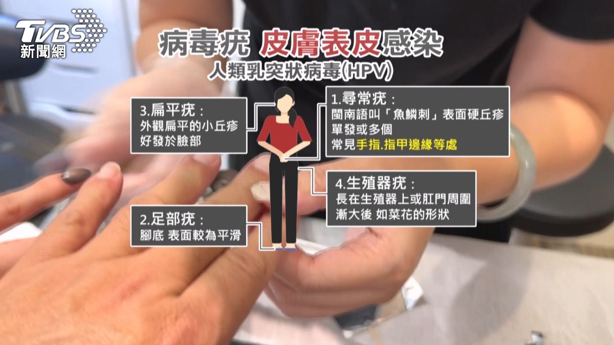 病毒疣全身各部位都有可能受感染。(圖/TVBS)