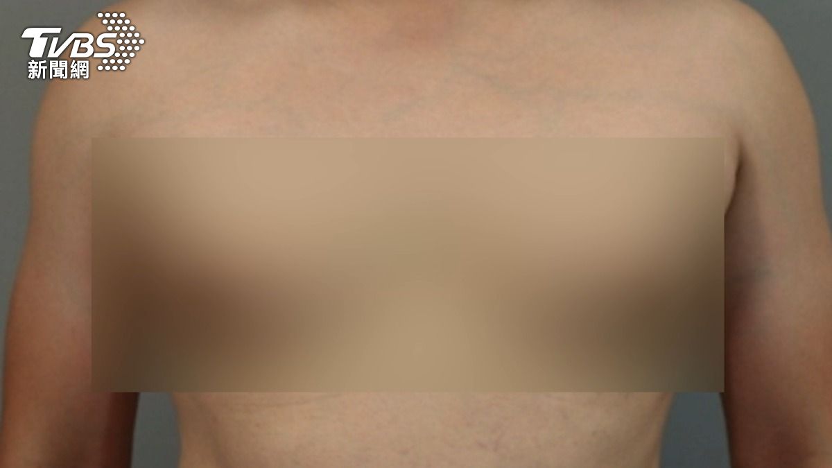 男性胸部腫大勿輕忽 醫揭女乳症恐罹「這重大疾病」警訊!