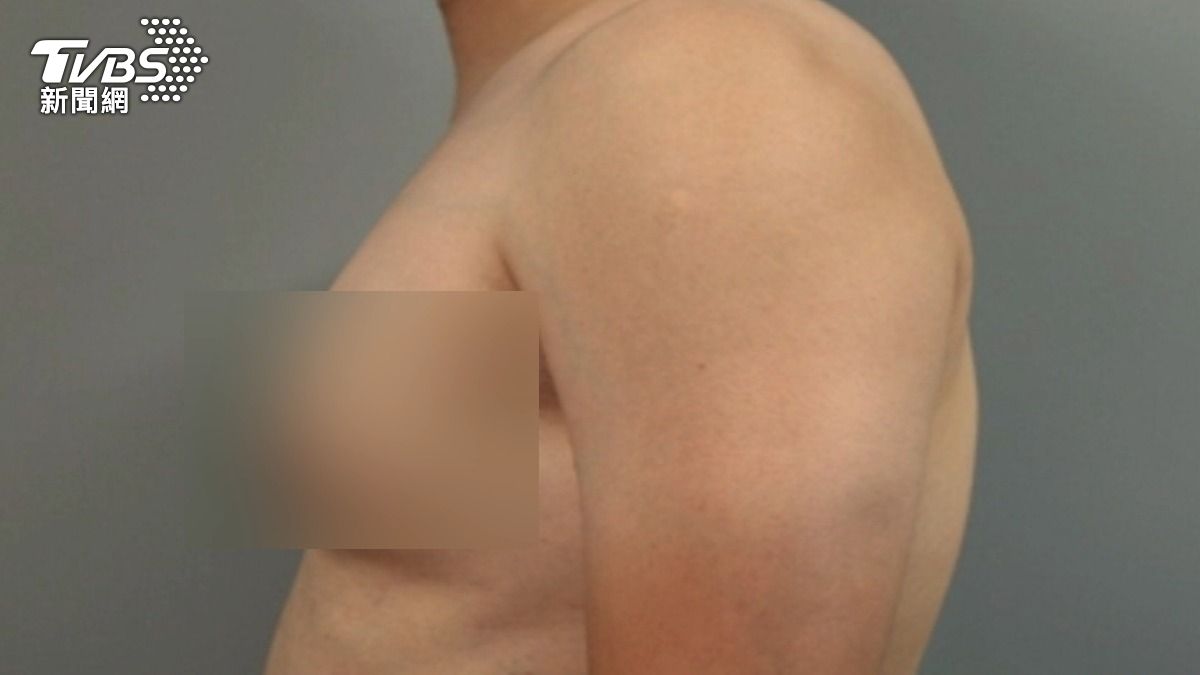 男性胸部異常腫大 小心女乳症與腫瘤警訊 (圖/TVBS)