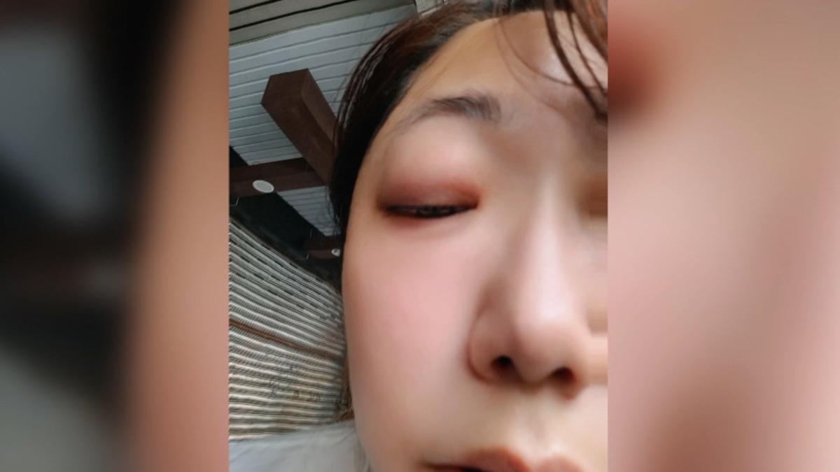 台中女遇登革熱藥劑 「眼睛腫脹」無法睜開。(圖/當事人提供)