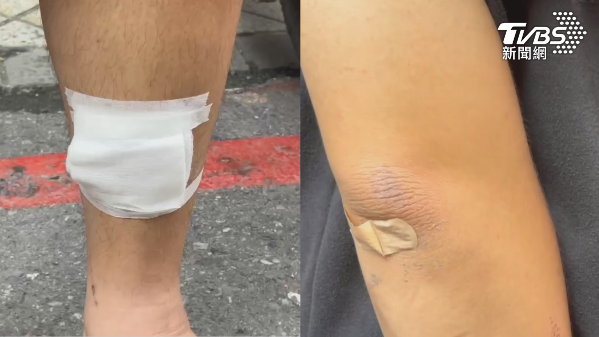 陳姓男子至今行走仍一跛一跛,腳踝與手肘還包著紗布與OK繃(圖/TVBS)