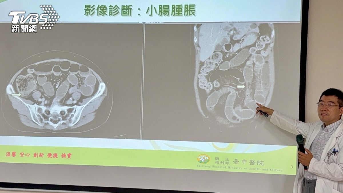 男同學腸道發炎腫脹合併積水。（圖／TVBS）