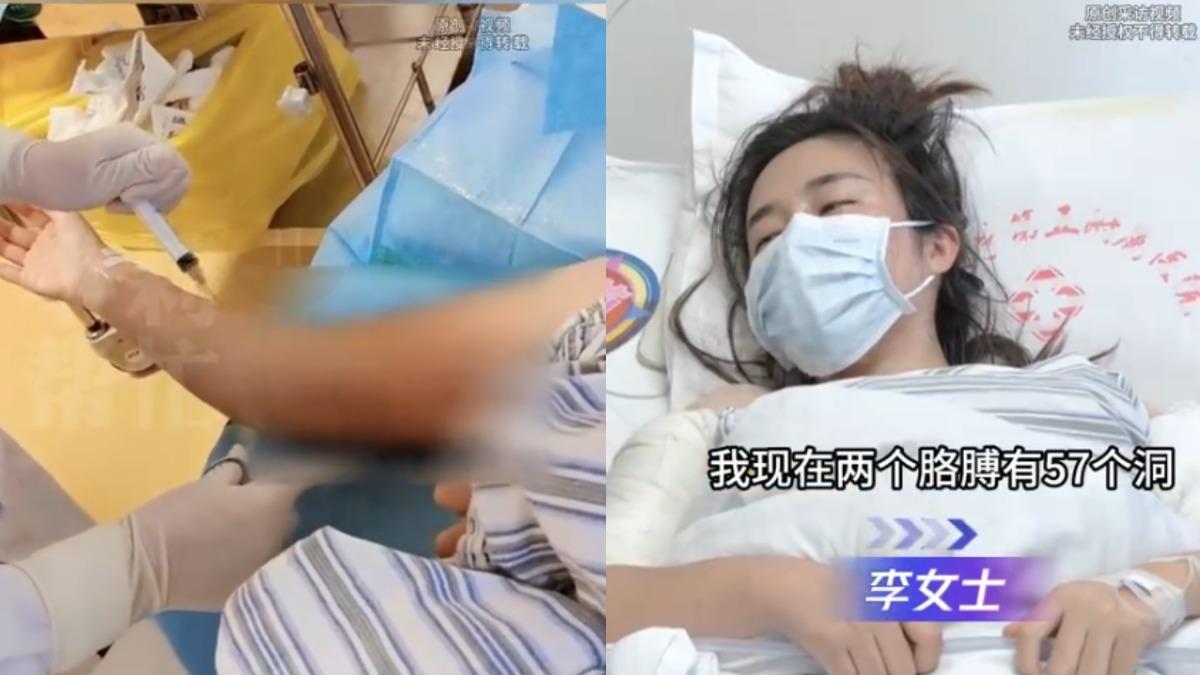 陸女愛美打「溶脂針」慘了!手臂潰爛、化膿 挖57個洞清創