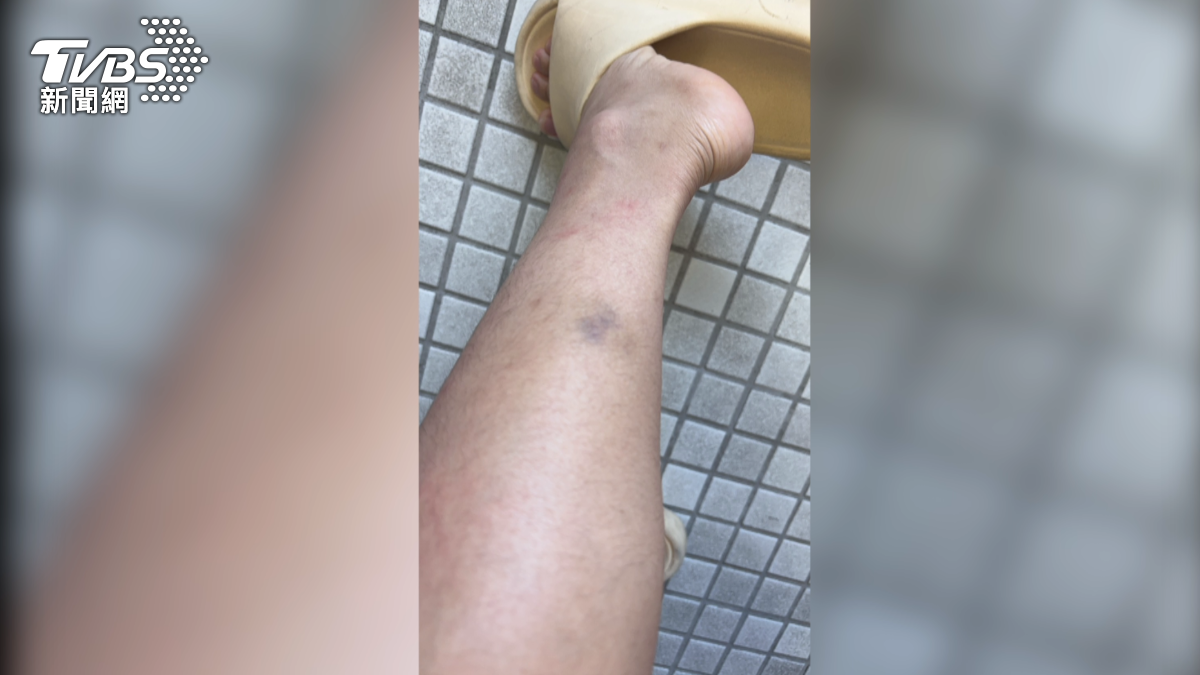 當事人黃小姐指控,搶包男不僅狂飆髒話,還對她動粗,導致她手腳留下瘀青。(圖/當事人提供)