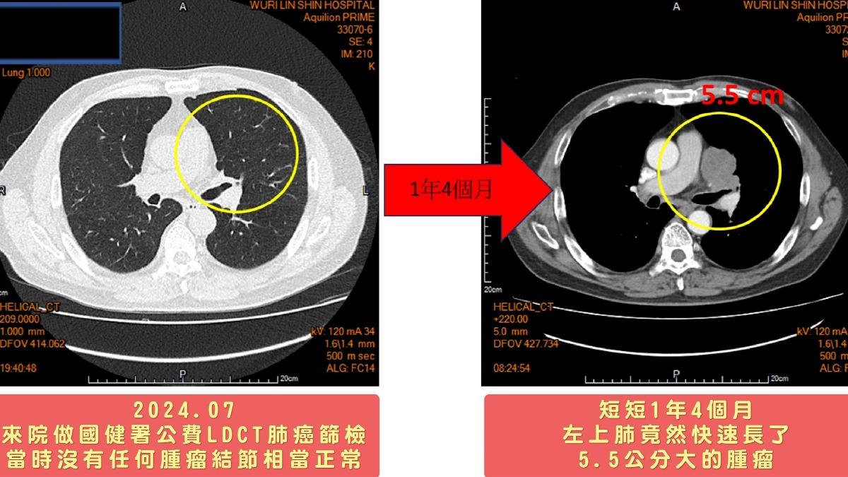 每天2包菸健檢沒事！台中男繼續抽隔年突癌末　剩3個月能活