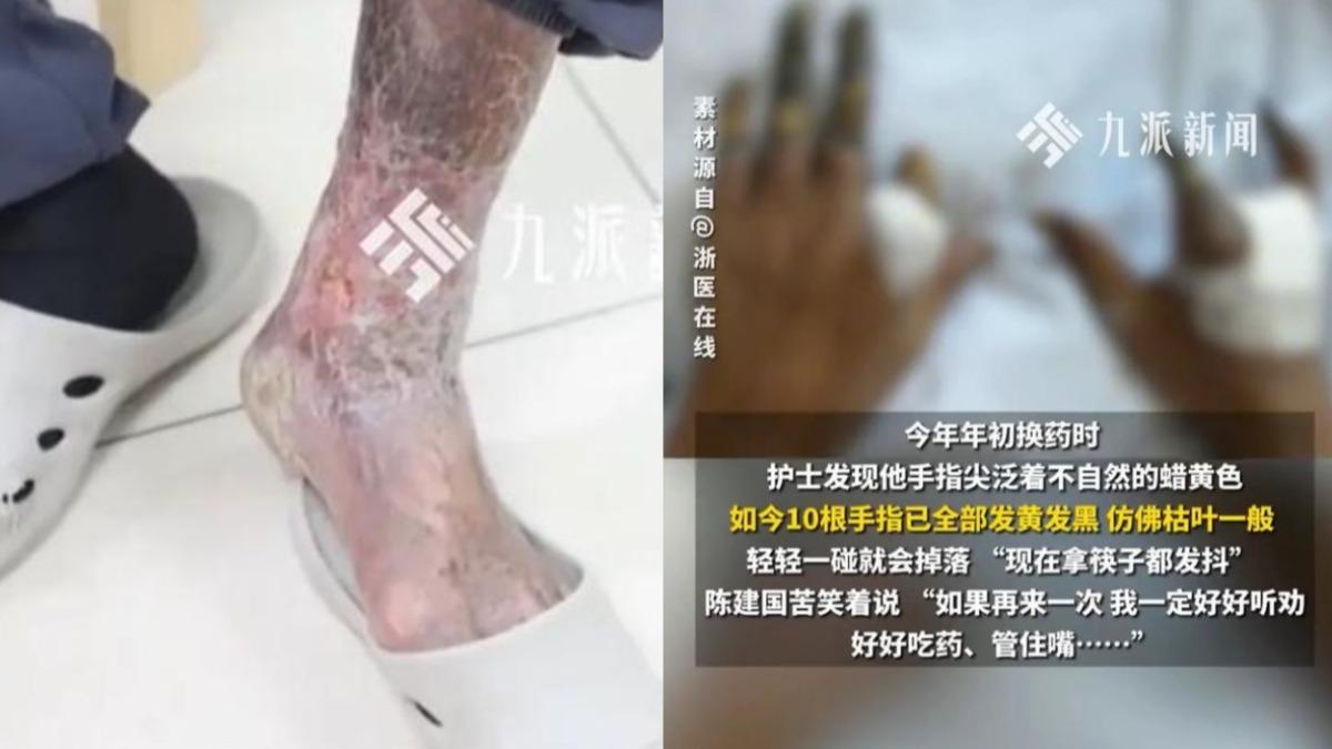 該男子最終10根腳趾依序潰爛，最終全被切除。（圖／翻攝自九派新聞）