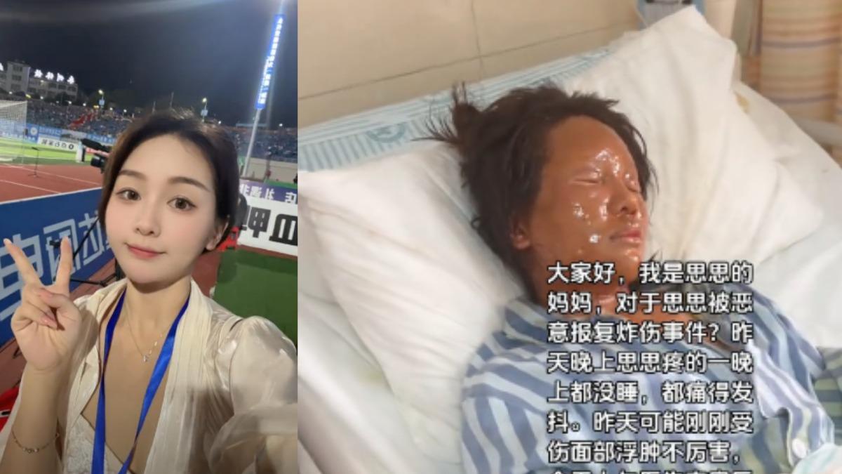 思思拿起放在鞋櫃上的包裹察看，沒想到包裹爆炸起火燃燒。送醫時她的臉部傷勢嚴重，眼睛更腫脹到「只剩一條線」。（圖／翻攝自抖音@Shushuy918）