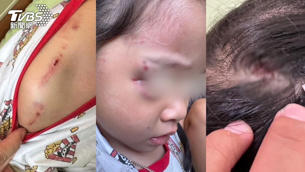 女童眼睛周遭、肩膀及頭部多處傷口,而9歲姊姊的手和腰部也遭咬傷。(圖/TVBS)
