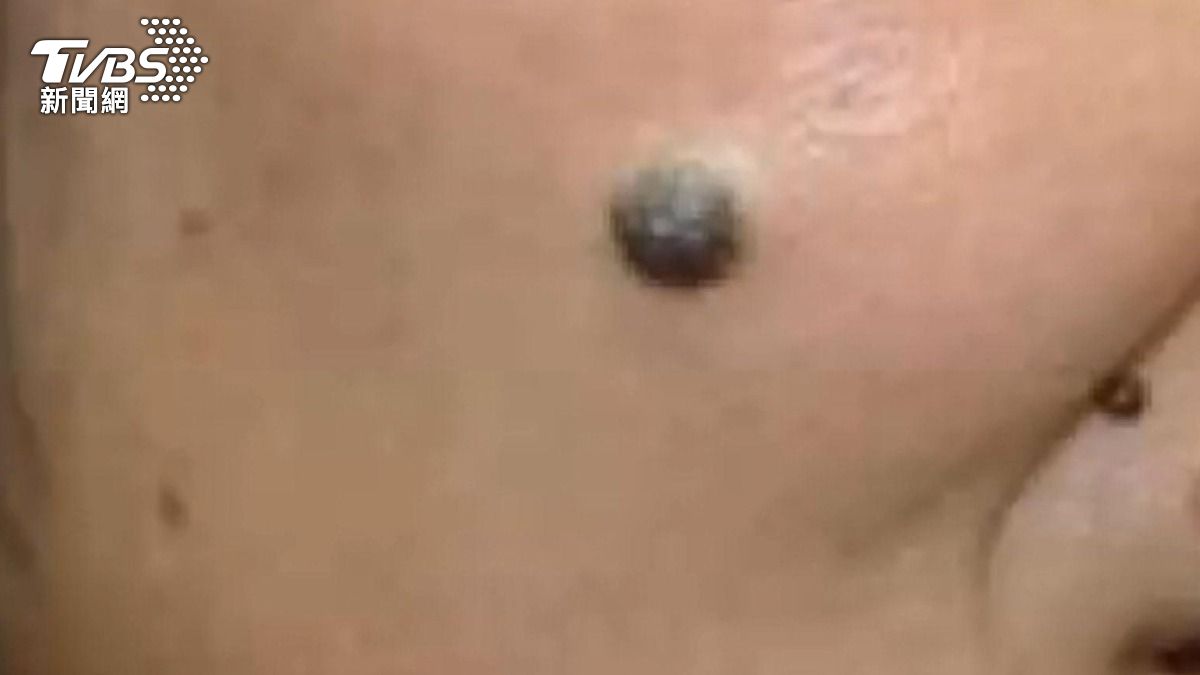 看似普通痘痘竟藏癌細胞? 醫:速就醫治療!