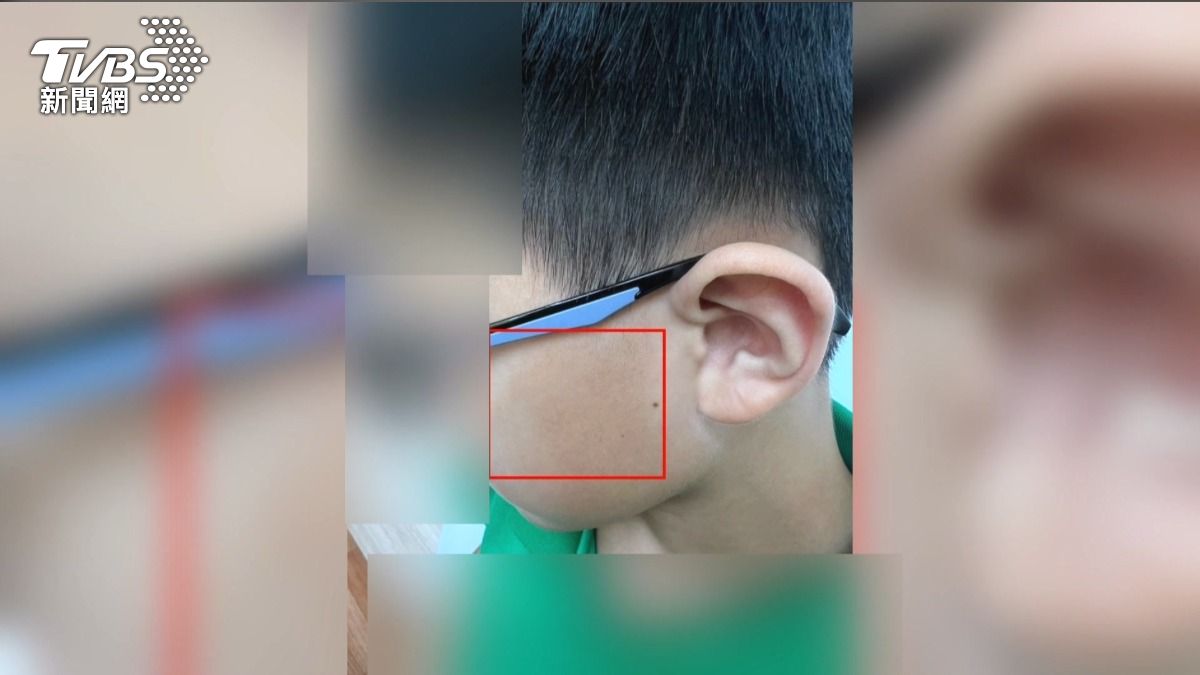  體育課球砸臉「國小生腦震盪」　家長控體育師霸凌。(圖／TVBS)  