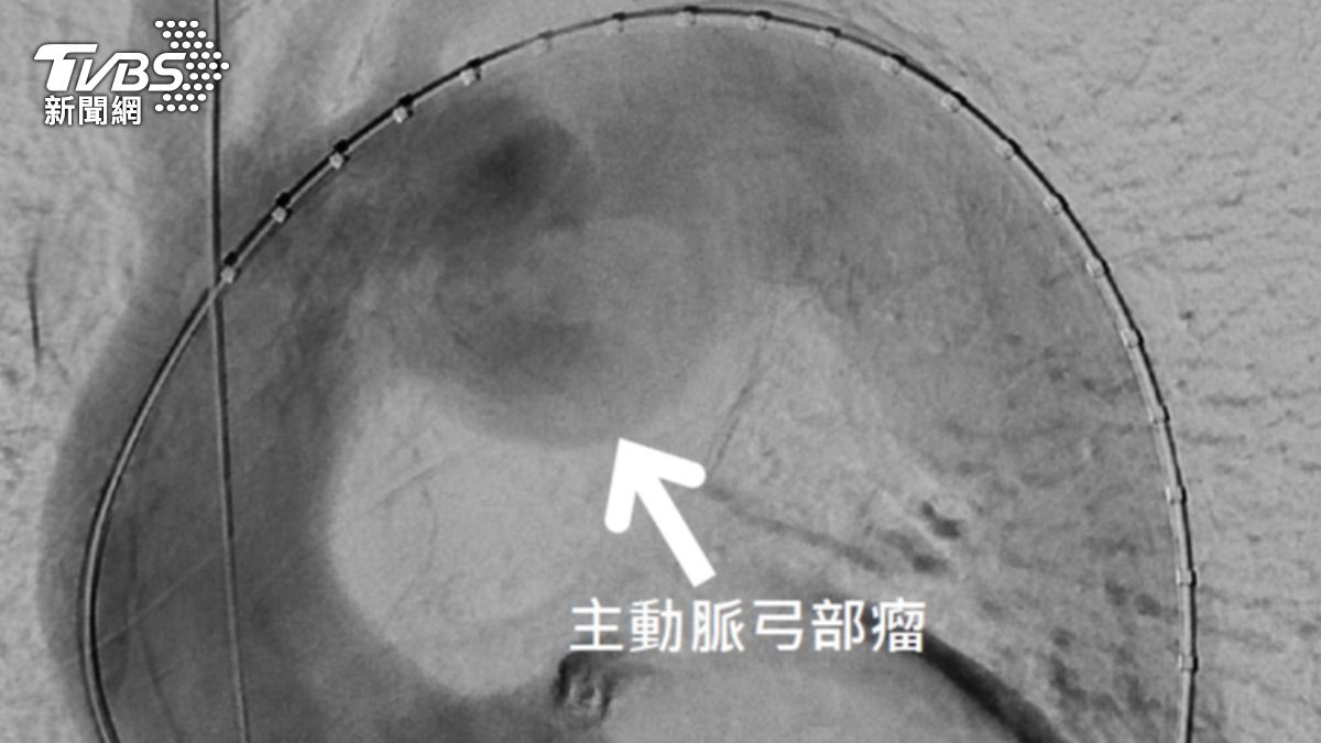 北榮創新療法!客製化胸主動脈開窗支架 成功救命! (圖/TVBS)