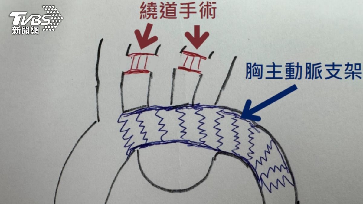 北榮創舉!「主動脈弓部瘤」免割脖子 繞道拆彈!   (圖/TVBS)