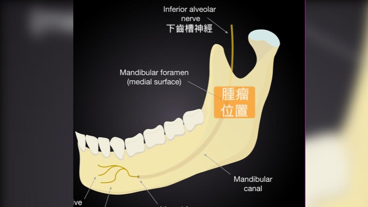 醫師表示在個案的腮腺深處的下頷骨發現腫瘤。(圖/張家豪醫師授權提供)