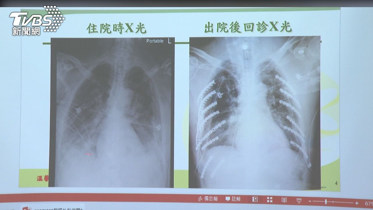 從X光片可以看到,患者兩側都有放置胸管。(圖/TVBS)