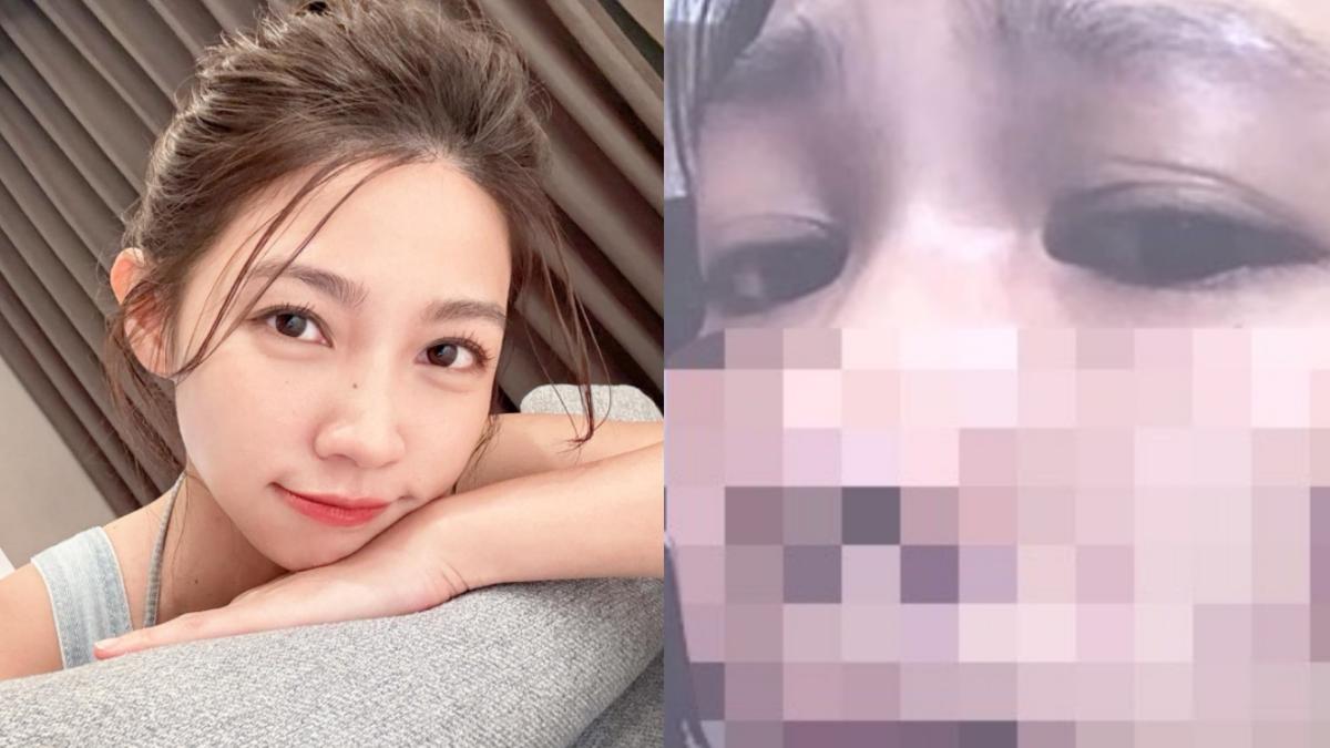 曾智希「跟風打雷射」漂亮臉蛋爛掉 罕見動怒:醫生不老實