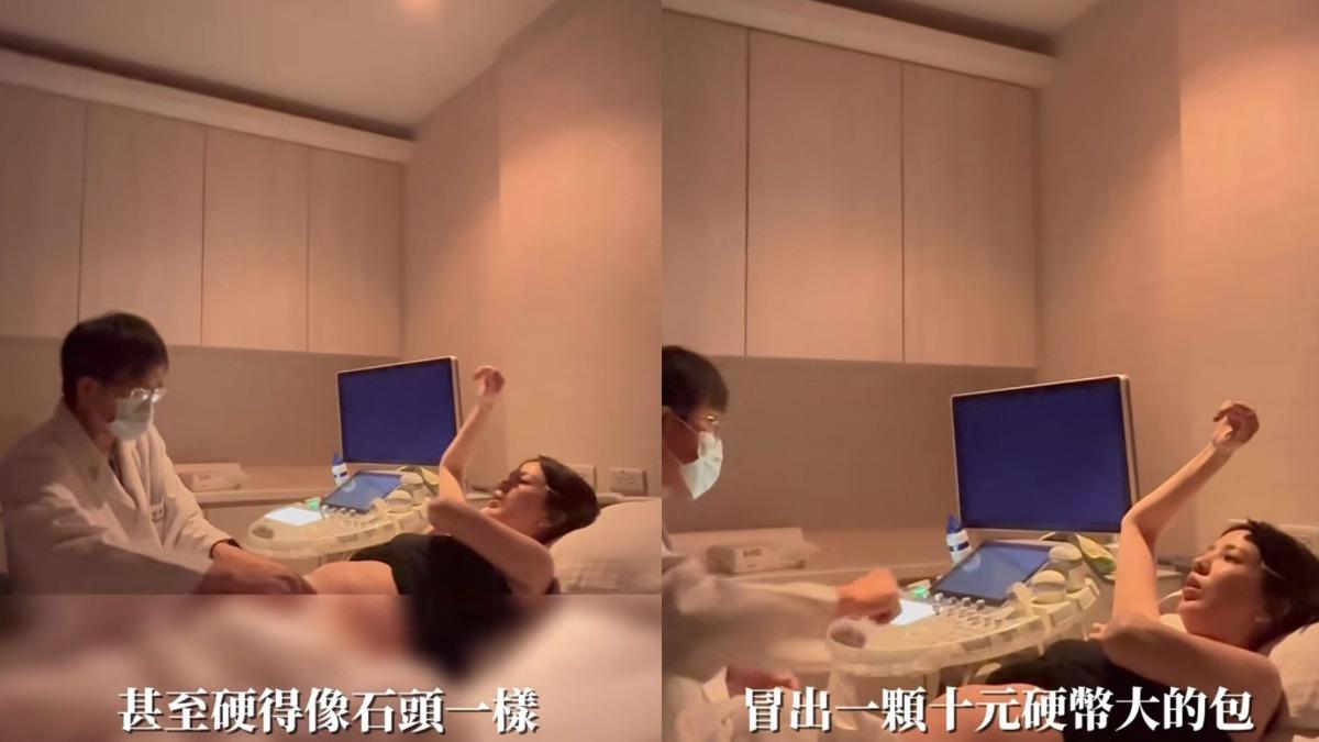 愛雅表示懷孕後胸部開始脹奶,甚至硬得像石頭一樣,而乳腺不通讓她腋下冒出十元大小的包。(圖/翻攝自Instagram/aiyachang1988)