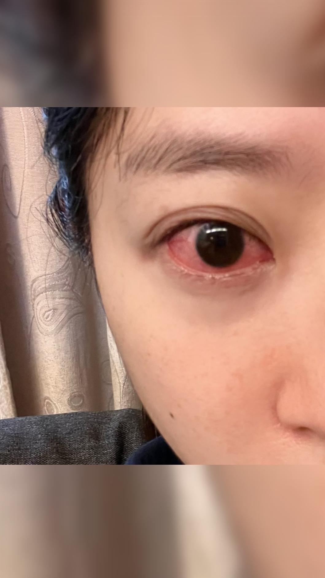 洪詩眼睛不適。(圖/翻攝自Instagram/angelhong)