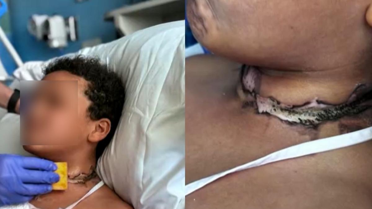 項鍊纏住充電線起火!男童睡夢中突爆炸 脖子燒傷送醫