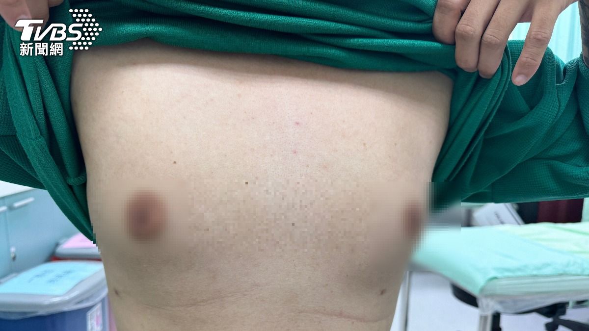 胸比女友還大!30歲男B罩杯 醫揭「女乳症」原凶